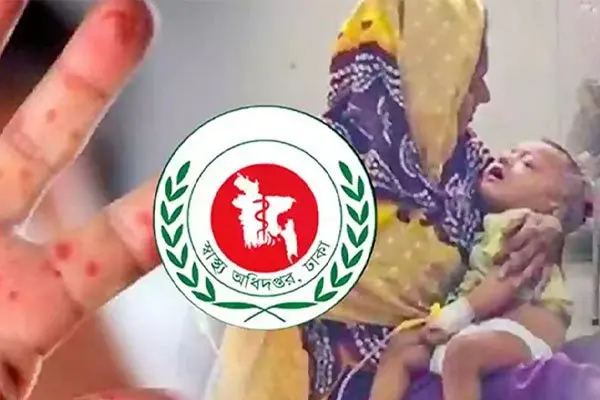 হামের উপসর্গে ২৪ ঘণ্টায় তিনজনের মৃত্যু, নতুন আক্রান্ত ১,৩৪৯